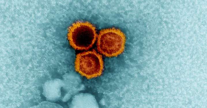 Lupus may be caused by the common Epstein-Barr virus, study finds