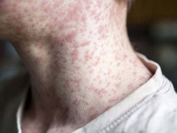Canada loses measles elimination status as outbreak continues