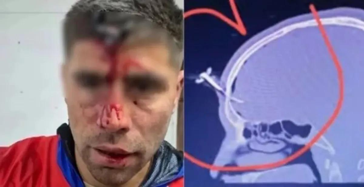 Brutal ataque a un futbolista del Ascenso: le clavaron una llave en la cabeza en plena pelea