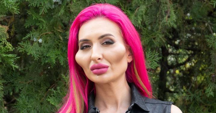 Woman with 'world's biggest cheeks' posts photo before fillers and it's so different