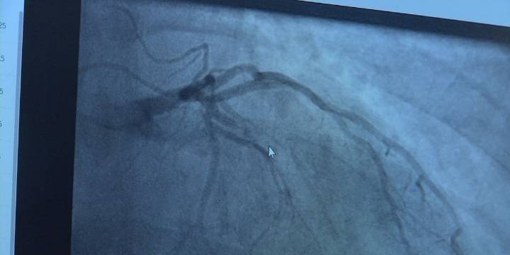 Heart failure, heart disease on the rise for people under 45