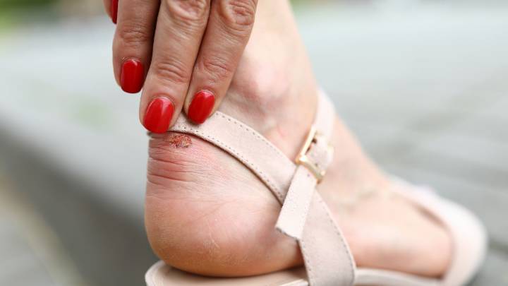 Cómo evitar las ampollas en los pies cuando usamos sandalias