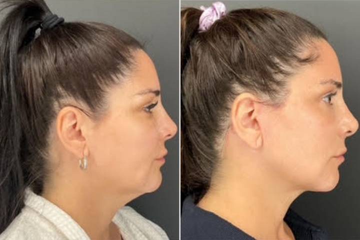 Woman, 52, Was Told She Was Too 'Young' for a Facelift — Before