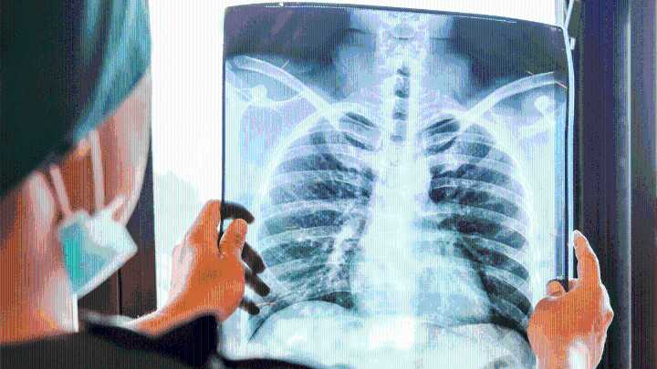 Cáncer de pulmón: aumentan los casos en Santa Fe y tienen un alto nivel de mortalidad