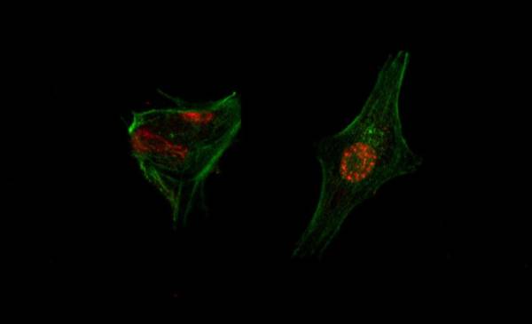 Conicet: logran eliminar la metástasis de cáncer colorrectal