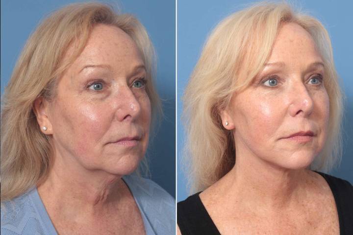 Woman, 62, Gets Facelift After Losing 50 Lbs. for Daughter's Wedding