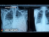 Troubling rise in young women getting lung cancer