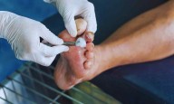 DFSI Launches WoundSights-National Certification Programme in Complex Wound and Diabetic Foot...