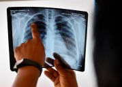 Pakistan among eight countries accounted for two-thirds of global TB cases