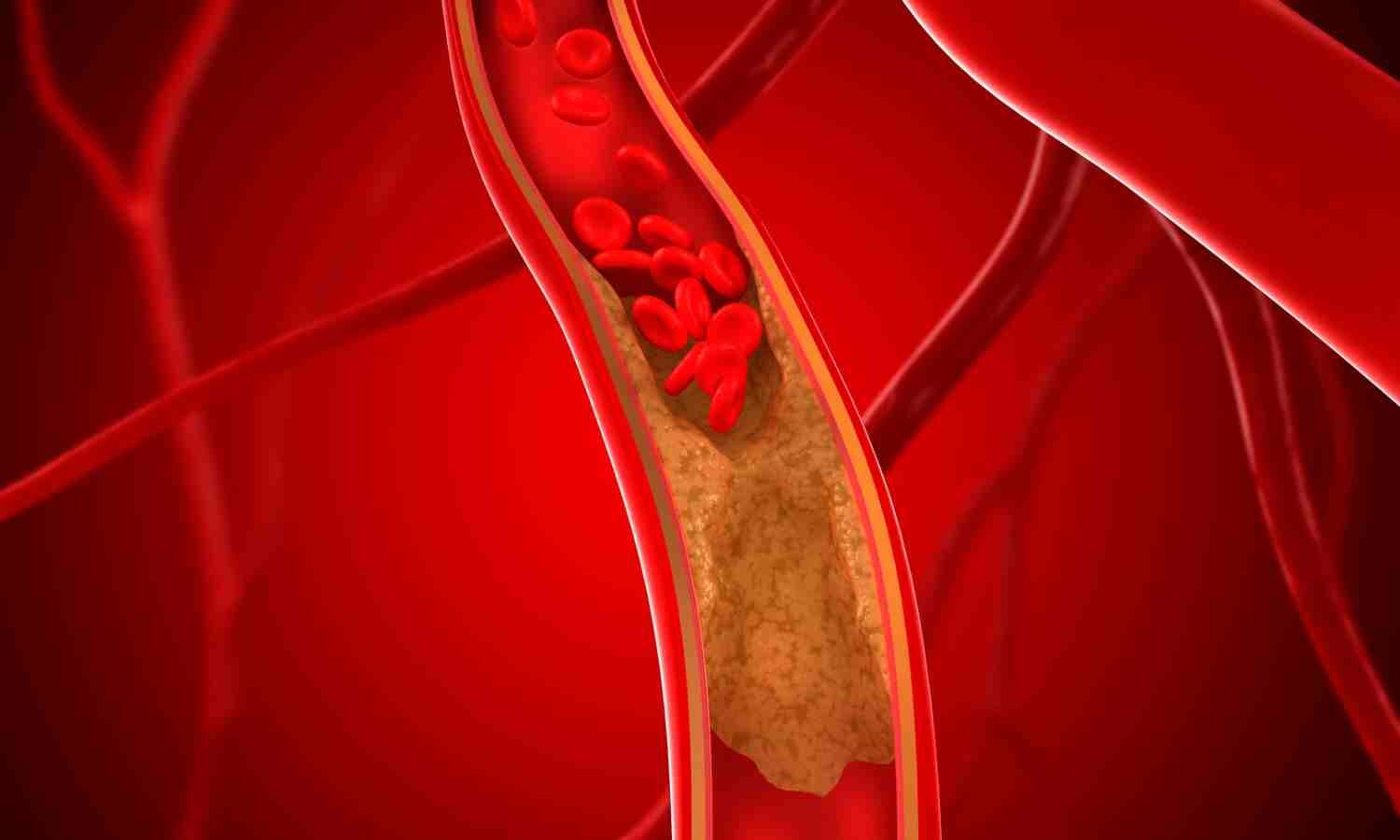 Coronary artery stenosis may protect patients from the effects of pulmonary embolism: Study