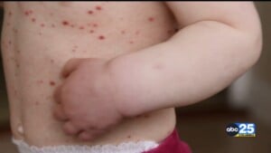 DPH confirms measles cases continue to grow in Upstate outbreak