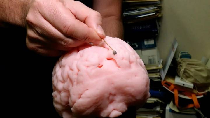 Así es el funcionamiento del nuevo implante cerebral español que logra que personas ciegas tengan percepción visual