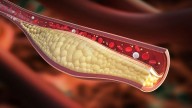 Por qué algunas personas tienen colesterol alto aunque lleven un estilo de vida saludable