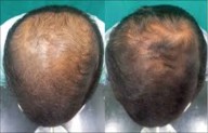 Thrice-Weekly Dutasteride Shows Greater Hair Density Gains but No Superiority Over Finasteride in...