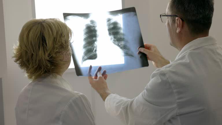 Ocho de cada diez casos se detectan tarde: estas son las cifras del cáncer de pulmón en Colombia