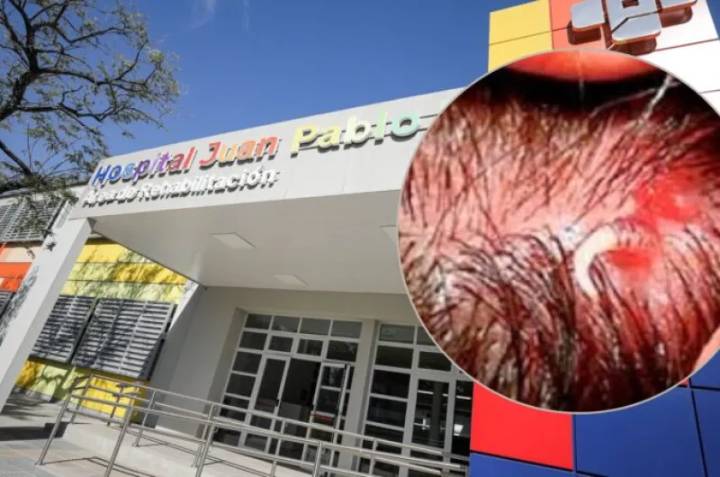 Una niña llegó al hospital Pediátrico con gusanos en la cabeza