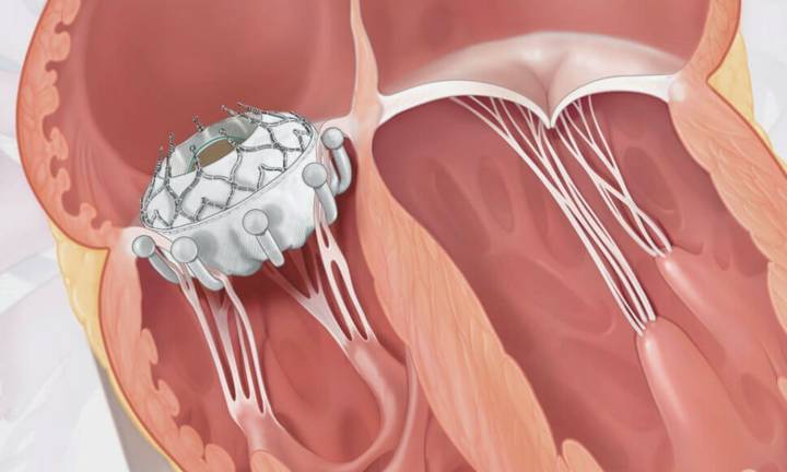 EVOQUE TTVR Delivers Promising Real-World Results: Over 97 Percent Achieve TR Elimination