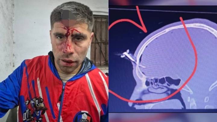 Una batalla campal terminó con un apuñalado en la frente con una llave