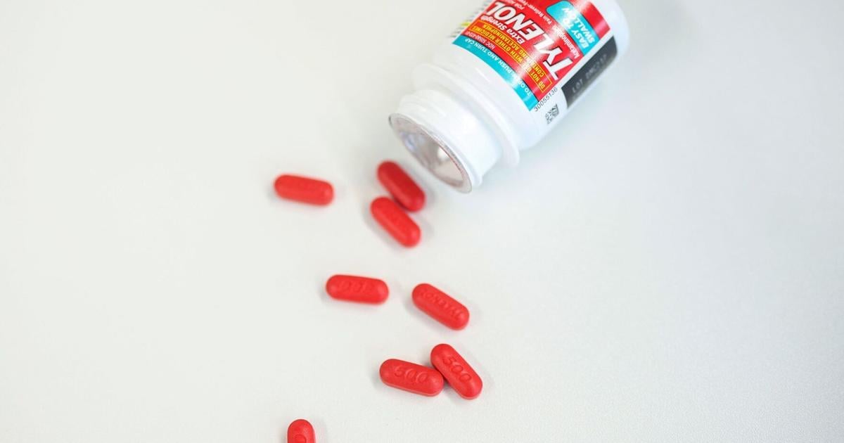 Acetaminophen use during pregnancy not clearly linked to autism, ADHD: Review