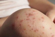 Emiten alerta por primer caso confirmado de sarampión en Hidalgo: un menor de Pachuca