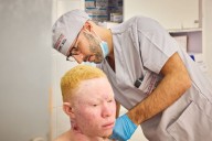 Isdin y África Directo alcanzan las 5.200 atenciones a personas con albinismo