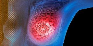 La verdad sobre el cáncer de mama y la píldora