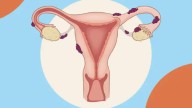 Endometriosis: Separating Myths From Facts