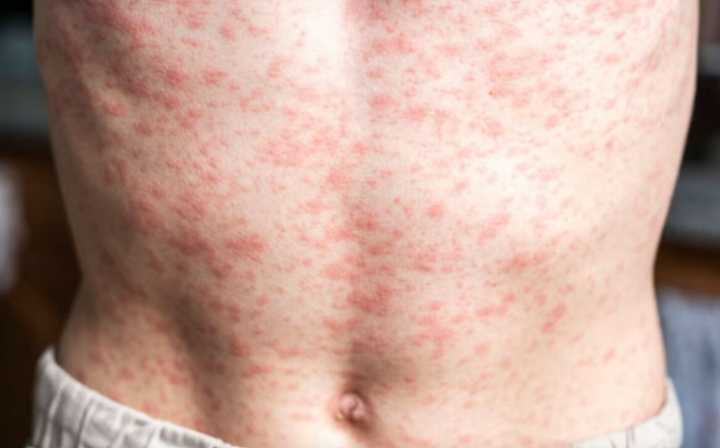 En México persiste brote de sarampión, afirma OPS