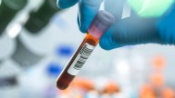 Servier India rolls out affordable biomarker testing for leukaemia and bile duct cancer patients