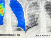 AI steps in to detect the world's deadliest infectious disease