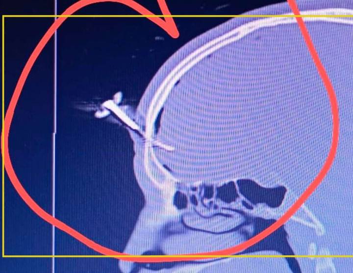 Apuñalado con una llave de auto en el cráneo durante una pelea