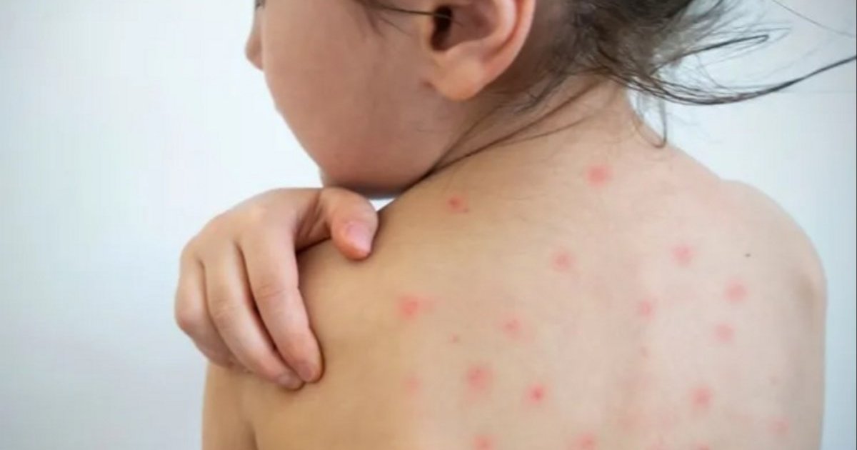 Alerta por sarampión en el país: qué pasa en Neuquén y Río Negro que refuerzan el llamado a la vacunación