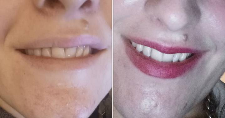 The Best Tooth Whitening Kit Black Friday Sale We've Seen