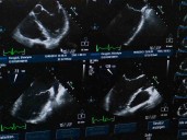 Mujer en Egipto descubre embarazo de nueve bebés; médicos alertan por el alto riesgo