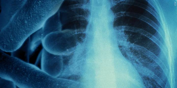 Marshall Co. may never find source of Legionnaires’ disease outbreak