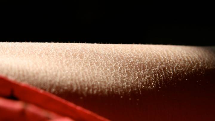 Canadian Woman Turns to Pillar of Salt After Failing to Apply Adequate Levels of Moisturizer