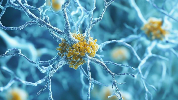 MCI, Dementia Risks Up With Increasing Biological Severity of Alzheimer Disease