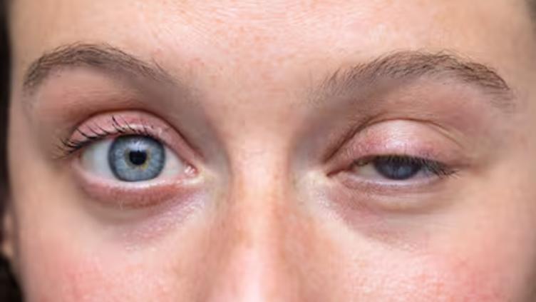 ¿Te tiembla el ojo? Estas son las causas más comunes