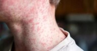 Everything you need to know as cases of measles spread in Greater Manchester