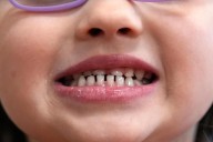 FDA restricts use of kids’ fluoride supplements citing emerging health risks