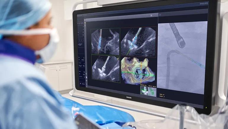 Philips, Edwards team on AI-based guide for mitral valve repair