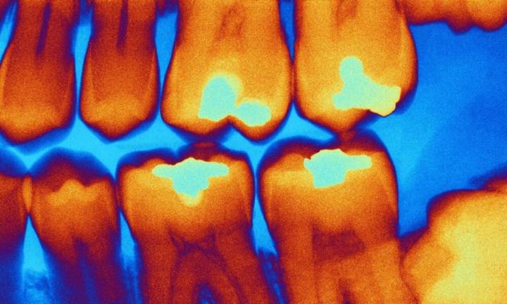 Caries en tiempo real: así diagnostican odontólogos en Rusia