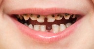 Yorkshire kids have worst teeth in UK as one place has 995 extractions in a year