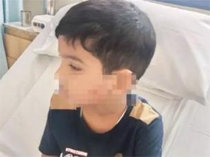 Mangaluru: 6-year-old boy injured in stray dog attack in Bajpe