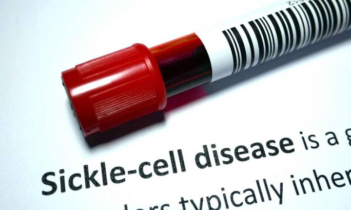 Biomarker can help predict preeclampsia risk in women with sickle cell disease: Study