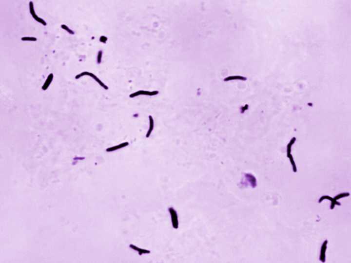 Tuberculosis kills 1.23 million people last year, WHO says