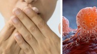 Cáncer y mal aliento: la señal silenciosa que podría anticipar una enfermedad grave
