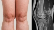 Lipedema: cuando la grasa se convierte en enfermedad