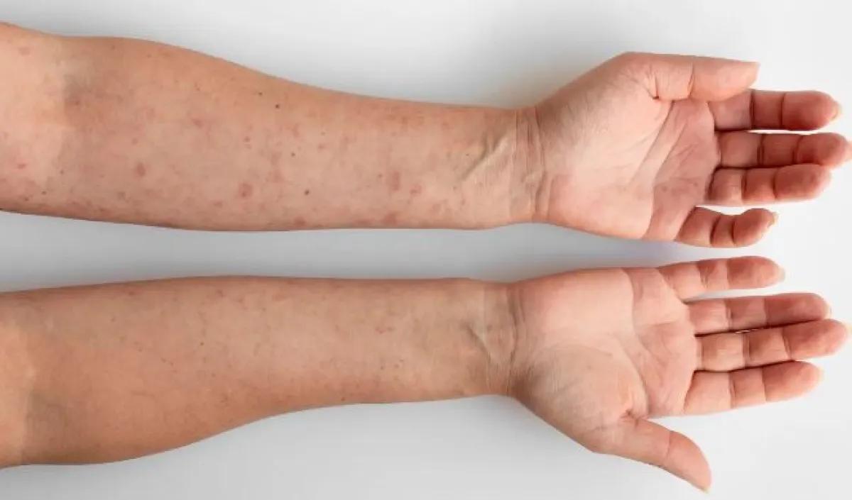 Casos de sífilis: advierten un crecimiento constante especialmente en adolescentes, gestantes y cogestantes