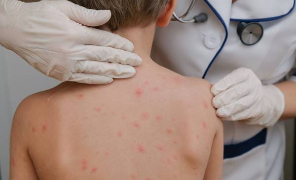 Confirman nuevos casos de sarampión en Argentina